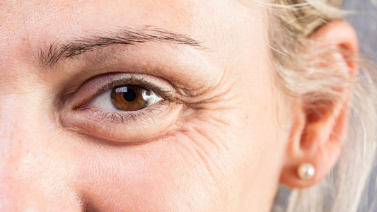 Natural Remedies to Reduce Eye Bags