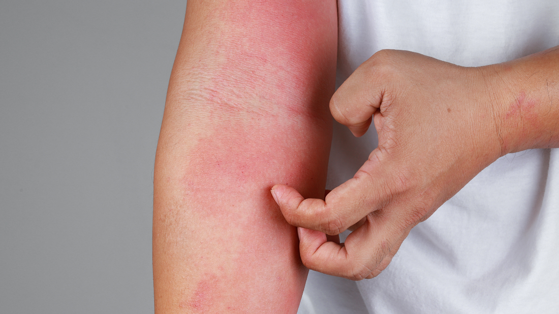 The Magic of CBD For Inflammatory Skin Conditions