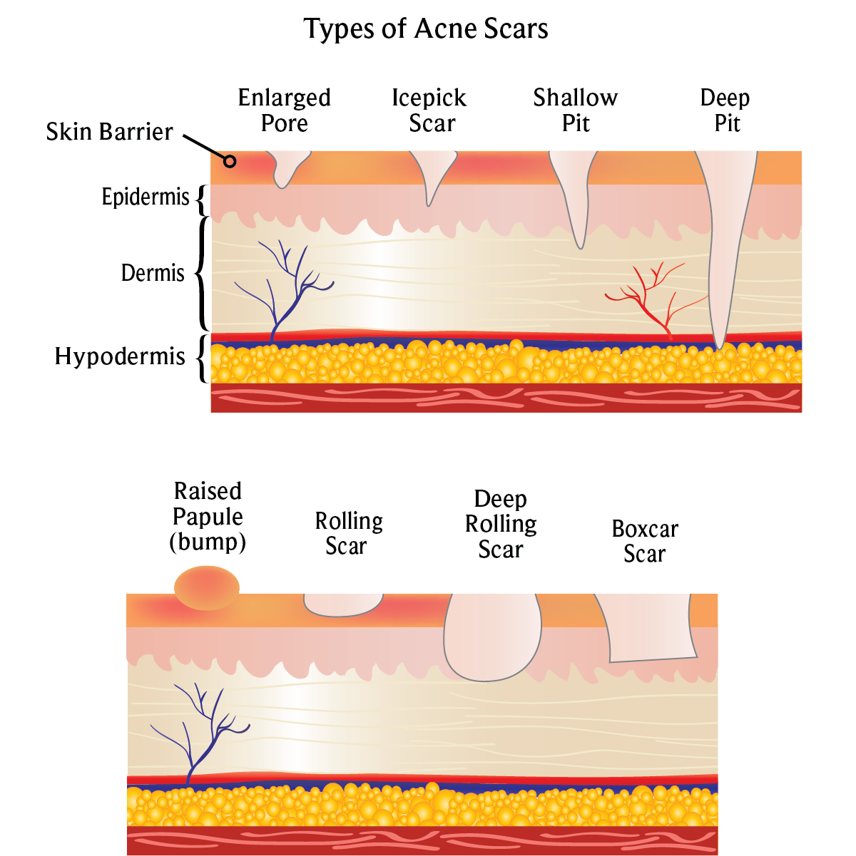 Acne_Scars