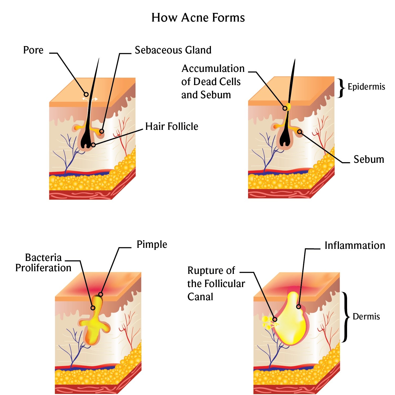 how_acne_forms