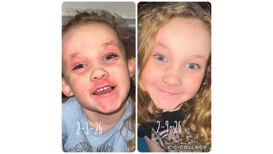 CBD Cream for Eczema: What Parents Should Know