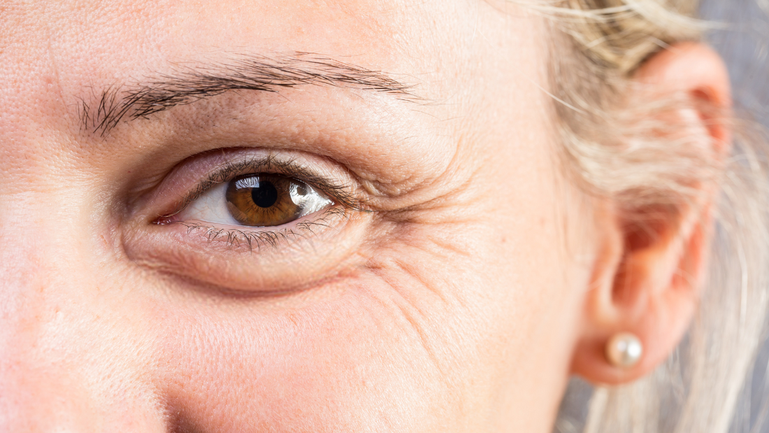 Natural Remedies to Reduce Eye Bags