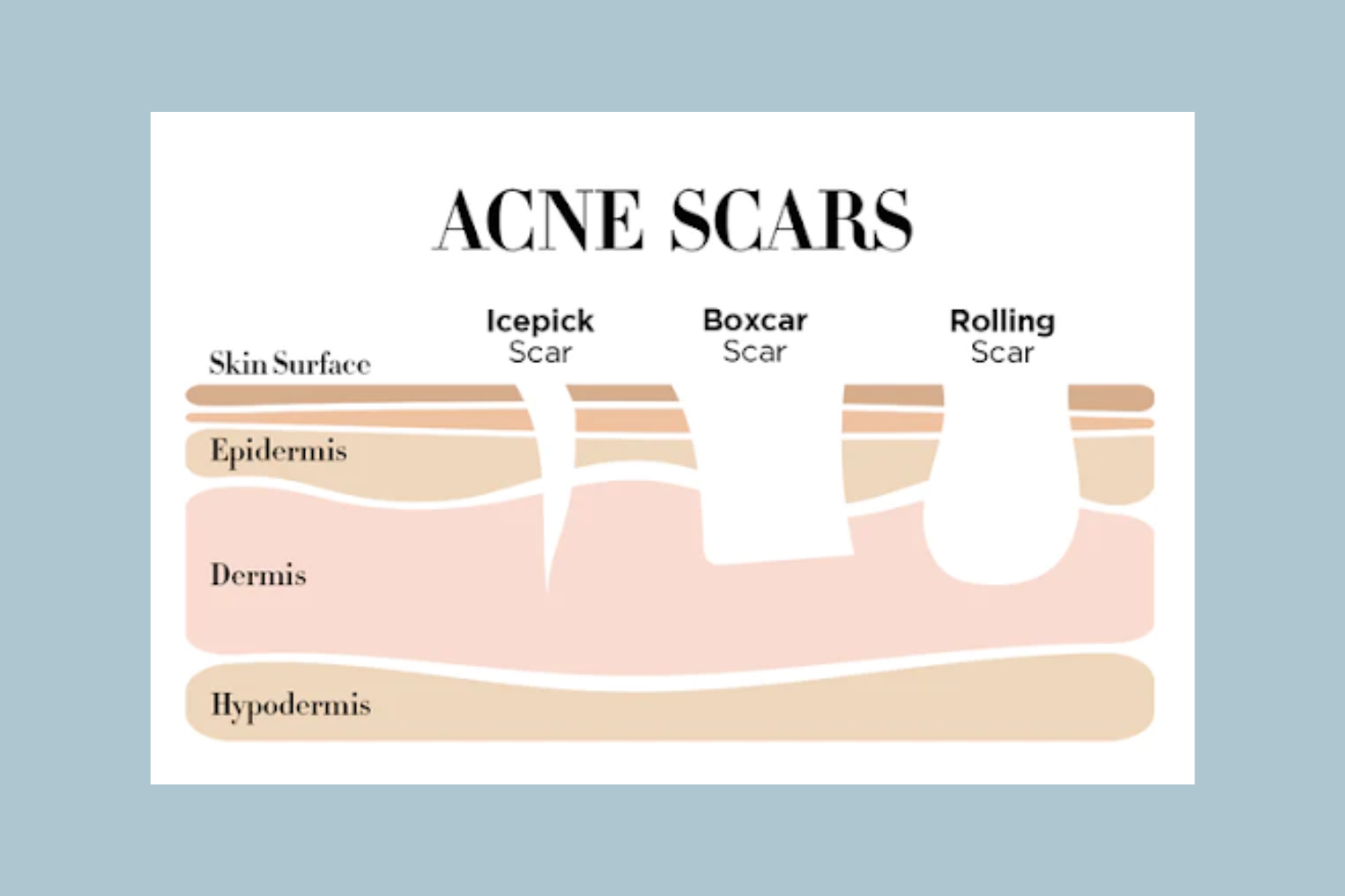 Pictured: Types of acne scars    Source: Averr Aglow
