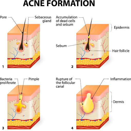 Pictured: Acne formation     Source: Mooresville Derm Center