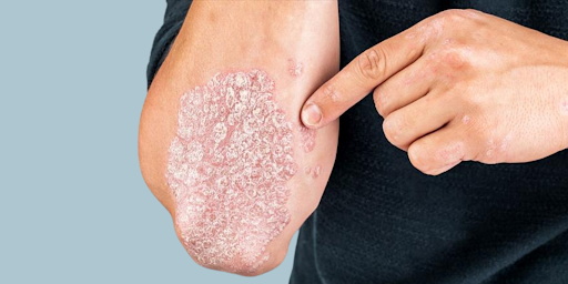 Psoriasis on elbow 